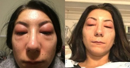 Isabelle Kun mala alergickú reakciu
