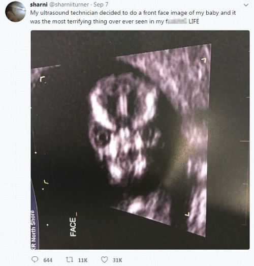 Sharni sa pochválila fotkou z ultrazvuku. 