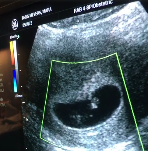 Manželka herca zverejnila smutný ultrazvuk.