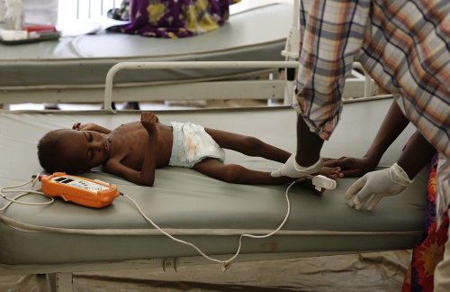 Lekár vyšetruje podvýživené dieťa v nemocnici v nigerijskom meste Maiduguri. 