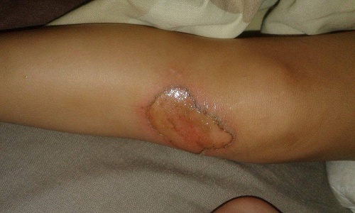 Alenka (2) utrpela popáleniny druhého stupňa na nohách a rúčke.