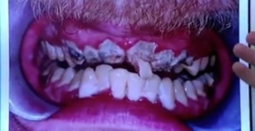 Mužovi museli vytrhnúť 11 zubov, ktoré už nevedeli zachrániť.