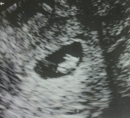 Tehotná žena uverejnila fotky z ultrazvuku.