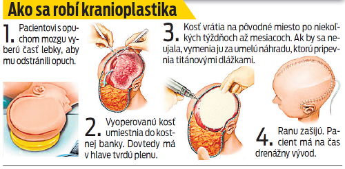 Ako sa robí kranioplastika