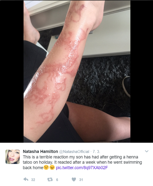 Tetovanie hennou spálilo chlapcovi nohu. 