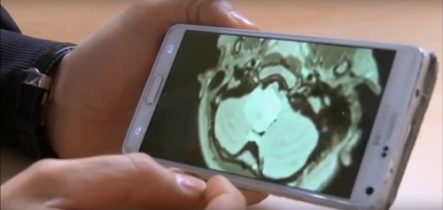Lekári si nevšimli v mozgu dievčatka veľký tumor. 