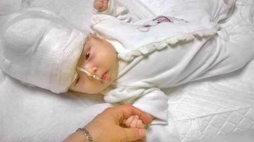 Milotka absolvovala prvú operáciu len pár týždňov po narodení, teraz ju čaká ďalšia.