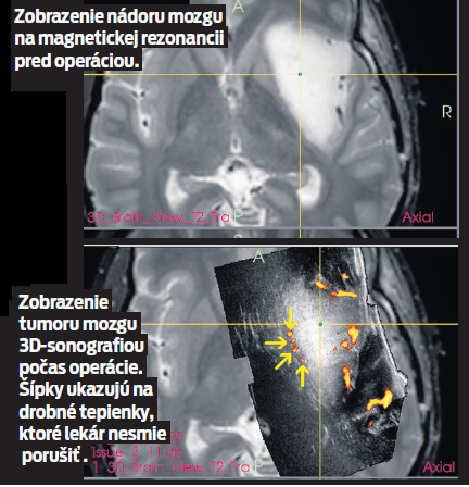Zobrazenie nádoru mozgu