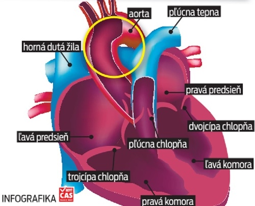 Hudobníka trápi srdcová aorta.