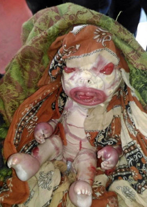 Dieťatko sa narodilo s genetickou poruchou zvanou harlekýnová ichtyóza.