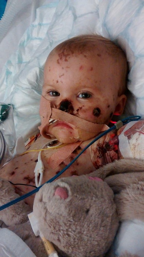 Dievčatko prekonalo meningitídu, ktorá ju pripravila o končatiny.