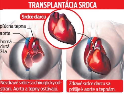 Transplantácia srdca.