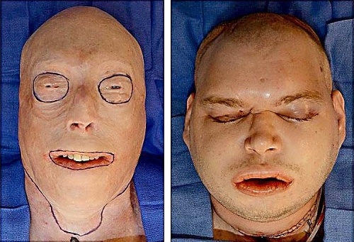 Požiar mužovi znetvoril tvár a transplantácia trvala 26 hodín.