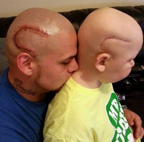 Otec si dal vytetovať na hlavu rovnakú jazvu, ako má jeho syn po vážnej operácii.