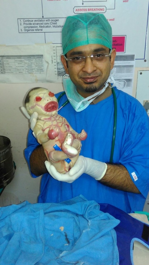 Dieťatko sa narodilo bez kože. 
