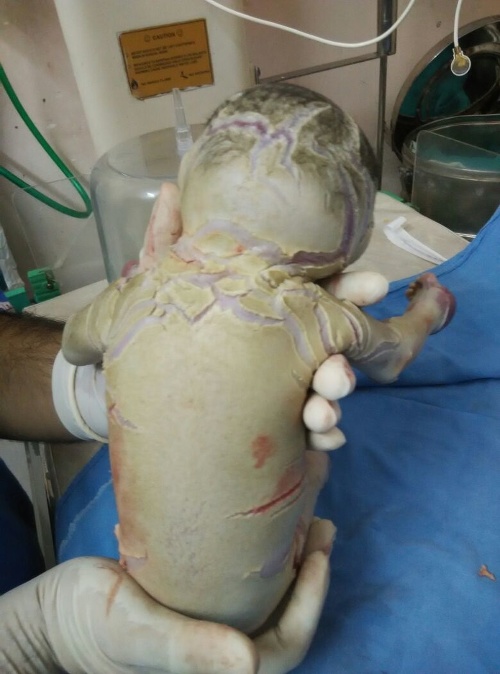 Dieťatko sa narodilo bez kože. 