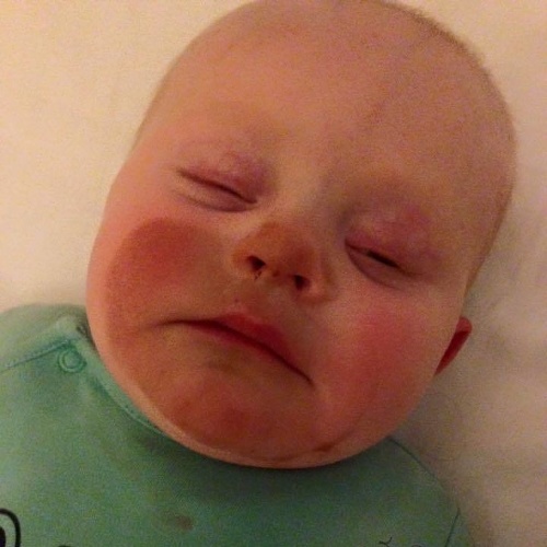 Synčekovi po kŕmení zhnedla časť tváre, ktorú mal pritlačenú k prsníku.