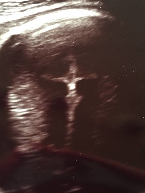 Alexandra si na fotke z ultrazvuku všimla niečo zvláštne.