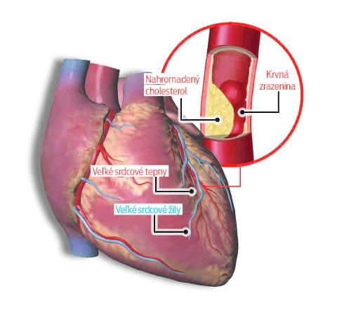 Ako vzniká infarkt myokardu