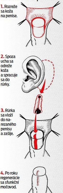 Priebeh unikátnej operácie.