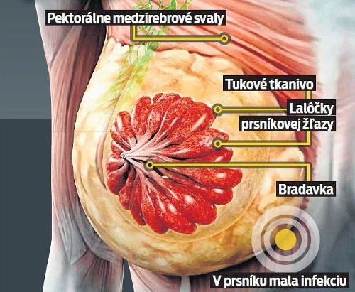 Nikoleta mala v prsníku infekciu.
