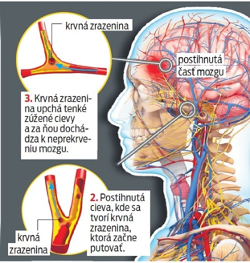 Môže to byť mozgová príhoda.