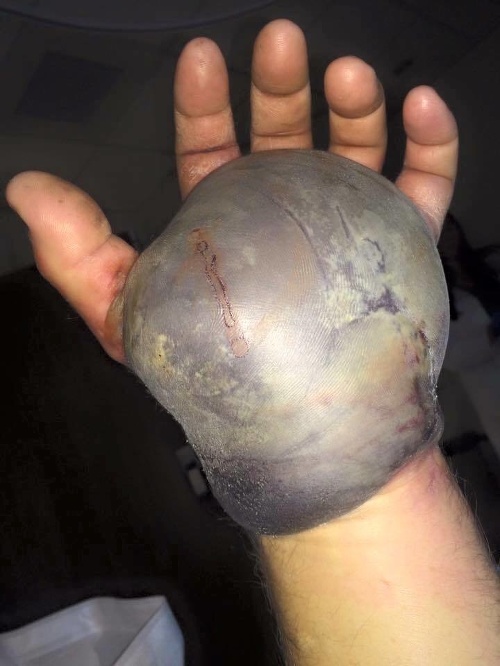 Takto vyzerá zranená ruka po uhryznutí štrkáčom.