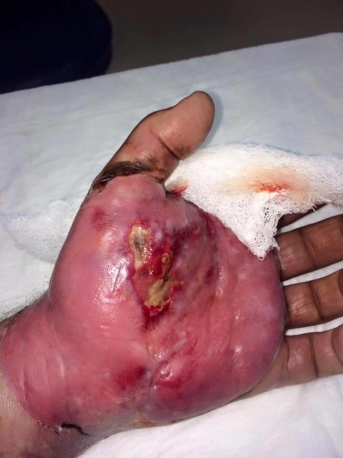Takto vyzerá zranená ruka po uhryznutí štrkáčom.
