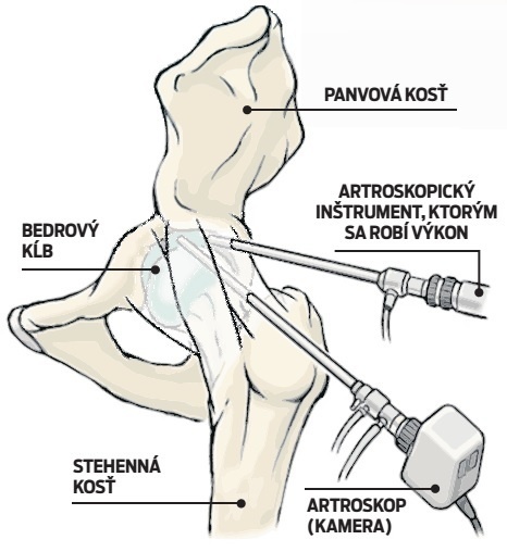 Kiskovi operovali bedrový kĺb.