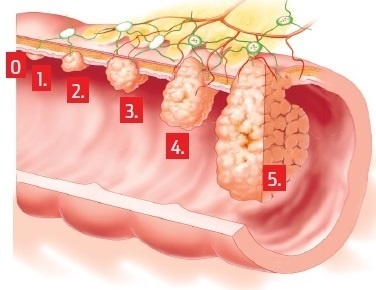 Vznik a priebeh rakoviny hrubého čreva.