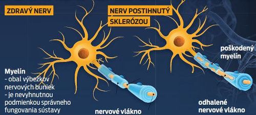 Zdravý nerv - nerv postihnutý sklerózou
