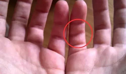 Tretí záhyb sa obyčajne nachádza na malíčku, avšak môže sa objaviť na ktoromkoľvek prste.
