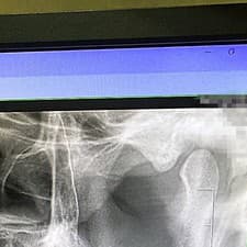 Röntgen odhalil zlomeninu dolnej čeľuste.