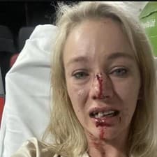 Sonja Wisemanová skončila s rozbitým nosom a vybitými zubami.
