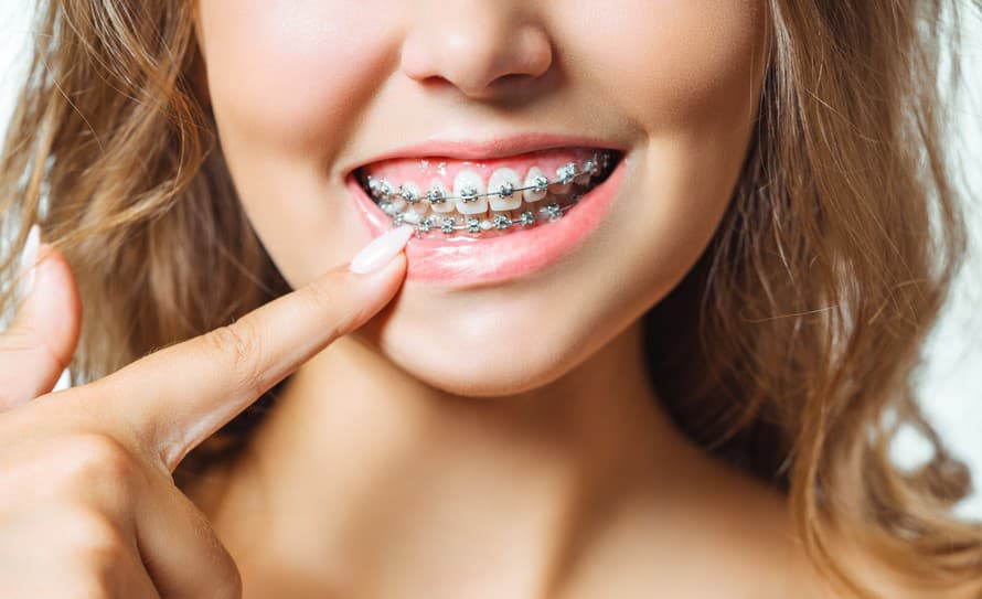Krásne biele, ale najmä rovné zuby má len veľmi malé percento populácie. Aké sú najčastejšie dôvody krivých zubov a čo sa s tým dá robiť?