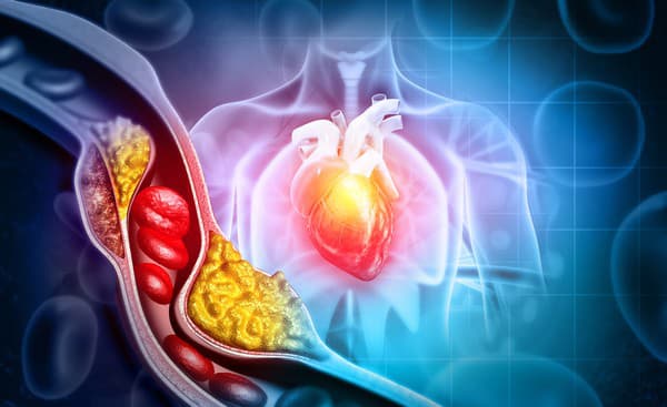 Cholesterolom zablokovaná tepna